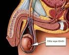 Testis Kanseri